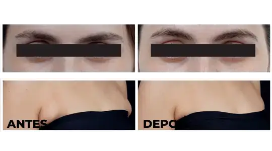 Ultraformer MPT - Dra Mirele Fadel - antes e depois - pálpebras e colo