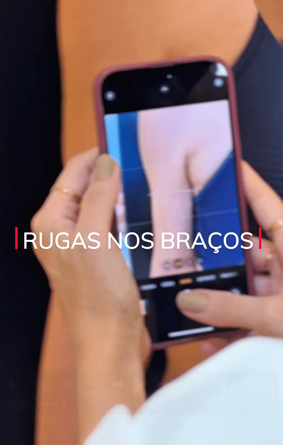 Rugas nos braços? Descubra como o Profhilo melhora a pele com resultado natural